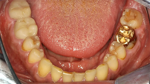 tratamiento-de-paciente-con-endocarditis-y-caries-activas